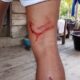 Diterkam Buaya Saat Memancing, Warga Marok Kecil Selamat Setelah Berjuang